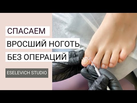 Видео: Вросший Ноготь. Что Делать Как Лечить Вросшие Ногти? Установка Титановой Нити.