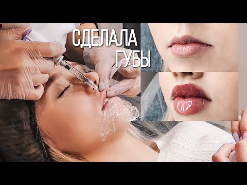 Видео: Я УВЕЛИЧИЛА ГУБЫ 😨 Реакция СВЕКРОВИ, ПАРНЯ и БАБУШКИ 🤬 Мой опыт 🔥