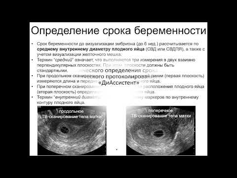 Видео: Ультразвуковые признаки беременности 5-6 недель 2022 05 03 14 31 32