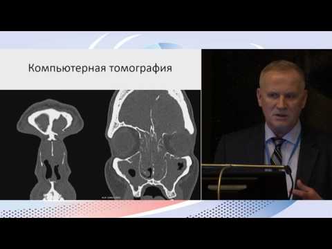 Видео: 12 Лечение полипозного риносинусита. Вчера, сегодня, завтра.