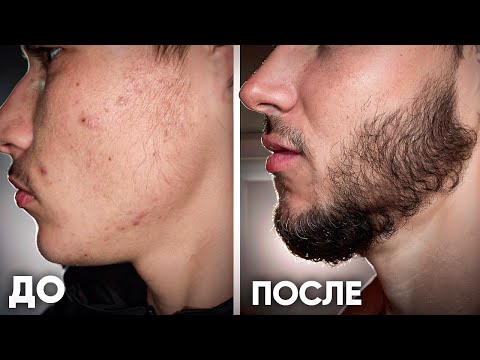 Видео: ОТРАСТИЛ СОЛИДНУЮ БОРОДУ за 6 месяцев / результаты Киркланд