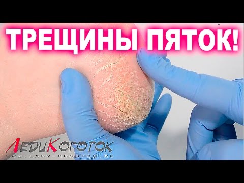 Видео: Классический педикюр. Трещины пятки. Как вылечить. Автор Елена Дзык