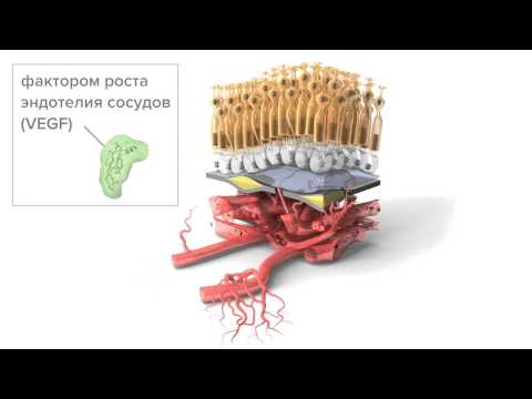 Видео: Прогрессирование влажной возрастной макулодистрофии