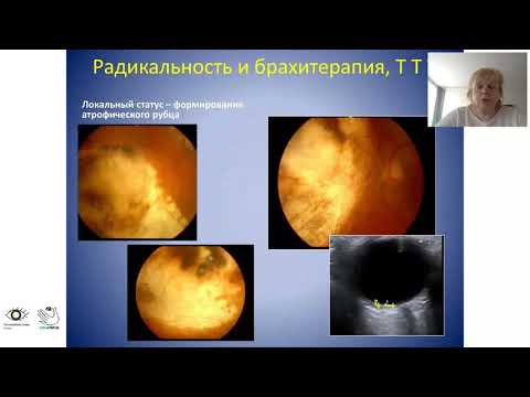 Видео: Качество жизни и выбор метода лечения «больших» меланом хориоидеи. Круглый стол ГП- 2020. В записи