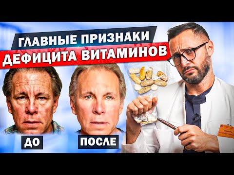 Видео: Внешние проявления недостатка витаминов. Витамины A, C, B, D, E, K