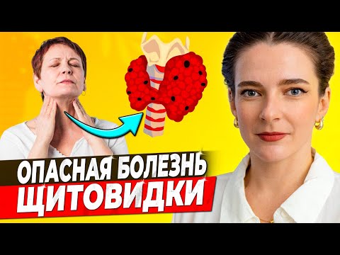 Видео: ❗️ АУТОИММУННЫЙ ТИРЕОИДИТ ❗️Основные симптомы, методы лечения, уровни гормонов на разных стадиях АИТ