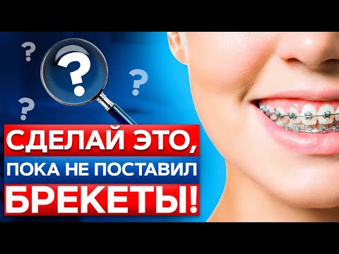 Видео: Установка брекетов от А до Я: как подготовиться к ортодонтическому лечению?