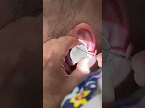 Видео: Достали гигантскую серную пробку!