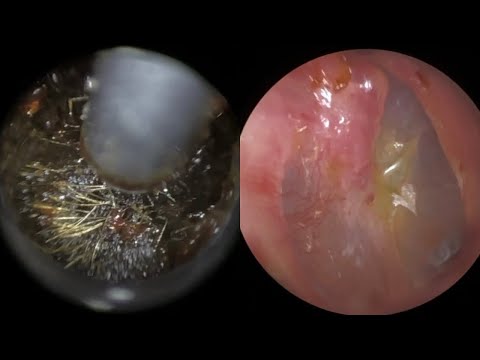 Видео: 142 - У 4-летнего ребенка болезненная ушная сера, плотно прижатая к барабанной перепонке, удалена...