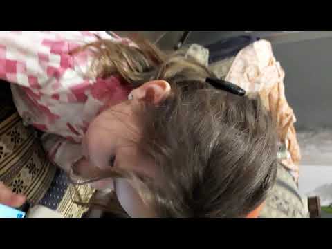 Видео: кохлеарная имплантация #Med-el Rondo 2  краткий обзор часть ll