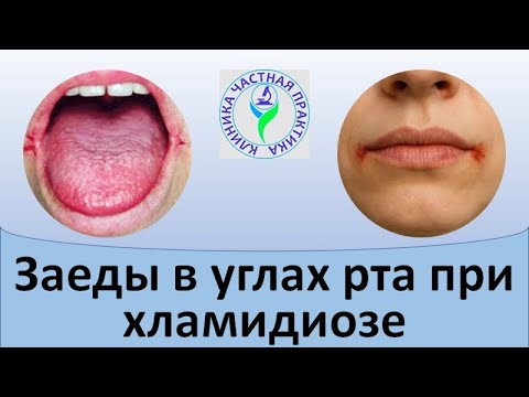 Видео: Заеды в углах рта при хламидиозе
