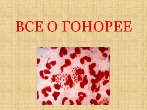 Видео: Гонорея. Гонорея у мужчин. Гонорея у женщин. Гонорея симптомы.
