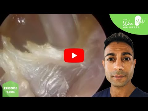 Видео: 1,003 - Удаление обтурирующего кератоза