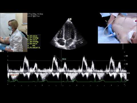 Видео: Оценка диастолической функции левого желудочка (д.м.н. Шульгина Л.Э.)