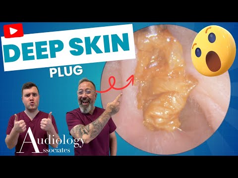 Видео: Глубокая кожная пробка удалена из уха! 😳 Вы не поверите, как это получилось! - EP1097