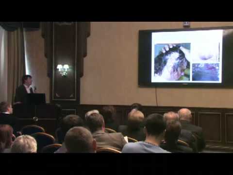 Видео: Ранняя диагностика меланомы кожи, роль дерматоскопии