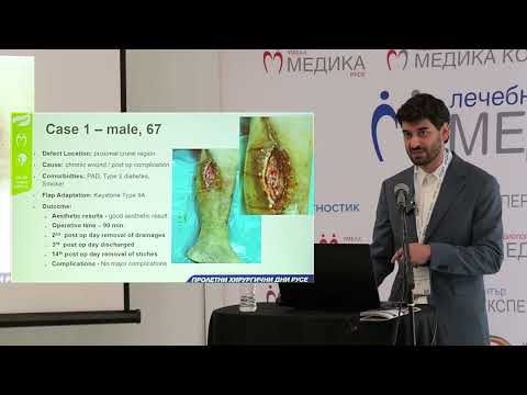 Видео: 60. Използване на Keystone ламбо при реконструкция на дефекти в различни области на крайниците ...