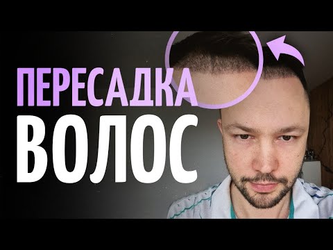 Видео: Пересадка волос и бровей. Все о процедуре. Мой личный опыт.