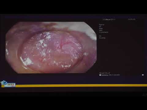 Видео: 36 Ткаченко ОБ Лечение ахалазии пищевода методом POEM