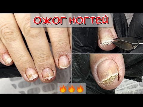 Видео: Ожог ногтей / Зачистка ногтя после ожога