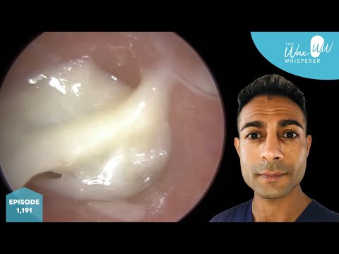 Видео: 1191 - Отсутствие ваты, гнойные выделения и удаление ушной серы