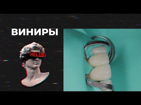 Видео: ВИНИРЫ