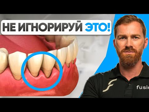 Видео: Делайте это, если у вас ОГОЛИЛИСЬ КОРНИ! Как лечить рецессию десны?