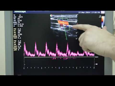 Видео: S6 05 Импульсный допплер