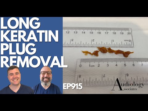 Видео: Удаление длинных кератиновых пробок - EP915
