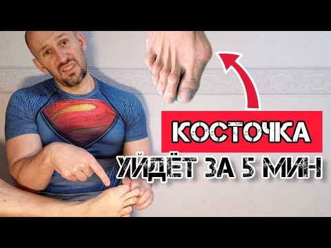 Видео: "Косточка" на большом пальце ноги уйдёт за 5 минут навсегда