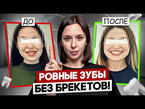 Видео: Ровные зубы без брекетов это реально? Путь к красивой улыбке!