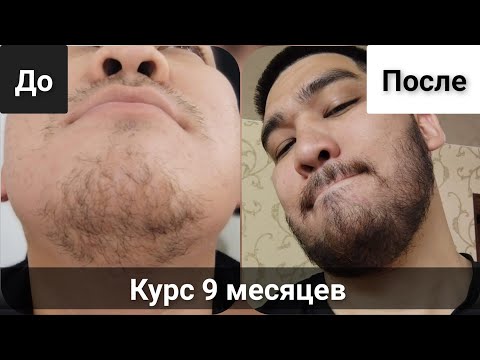 Видео: Пробую Минокс мой личный опыт использования. Борода до и после использования. Выпуск 88