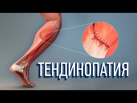 Видео: Тендинопатия. Как ее лечить? Что это такое?