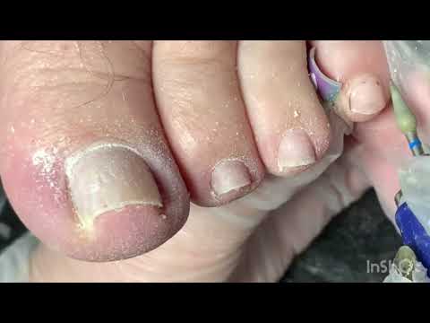 Видео: Вросшие ногти педикюр ￼￼￼