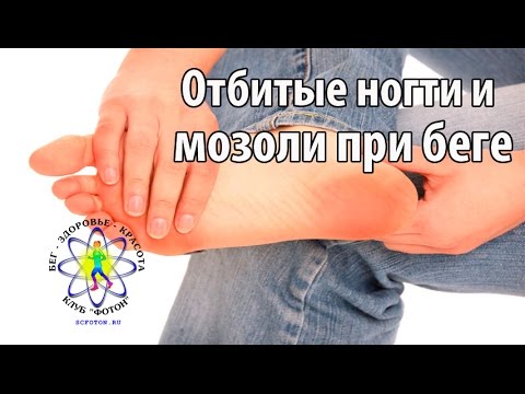 Видео: Отбитые ногти и мозоли на ногах из-за бега. Причины и лечение