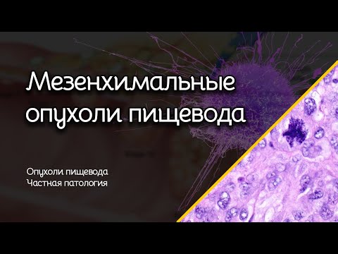 Видео: Мезенхимальные опухоли пищевода | Опухоли пищевода | Частная патология