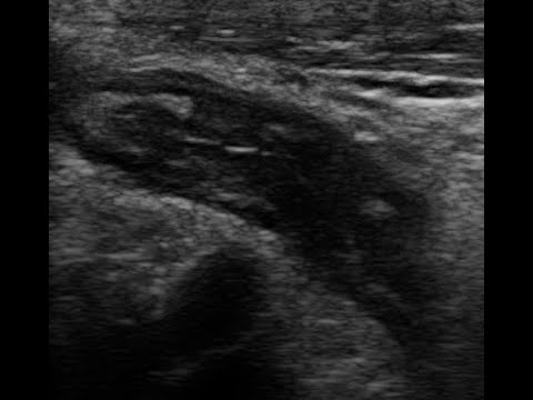 Видео: Острый аппендицит (УЗИ). Подборка случаев.