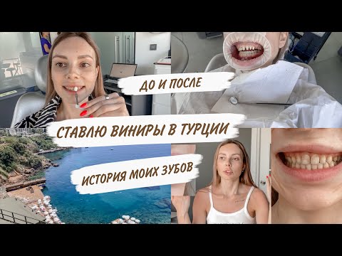 Видео: СТАВЛЮ ВИНИРЫ В smile team turkey 😳МОЙ ОПЫТ |ИСТОРИЯ МОИХ ЗУБОВ | ДО И ПОСЛЕ 🦷ВИНИРЫ И КОРОНКИ