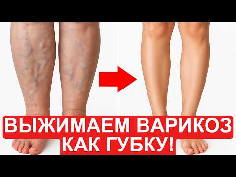 Видео: Варикоз и отеки ВЫЖИМАЮТСЯ как губка! | Только ЭТИ УПРАЖНЕНИЯ спасают