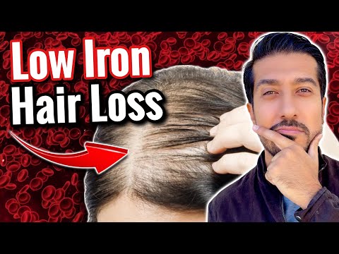 Видео: Дефицит железа и выпадение волос | Вызывает ли дефицит железа выпадение волос?