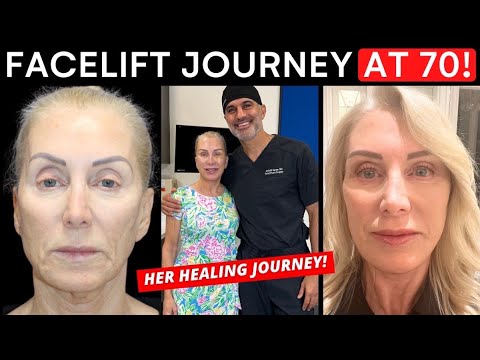 Видео: Преображение после подтяжки лица в 70 лет: до и после полного восстановления!