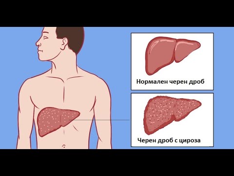 Видео: Пациентите с цироза не са обречени!