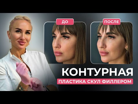 Видео: Контурная пластика скул филлером