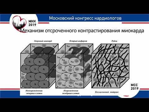 Видео: Е. А. Мершина. Применение МРТ в диагностике ИБС и кардиомиопатий.