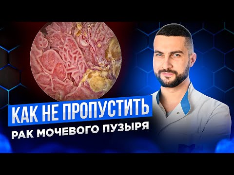 Видео: Рак мочевого пузыря | Какие симптомы нельзя игнорировать