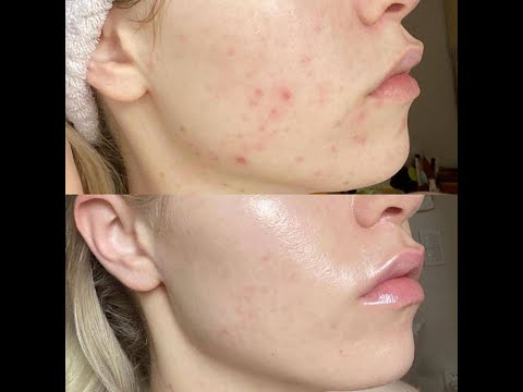 Видео: АКНЕ — как вылечить и не сойти с ума 🌿