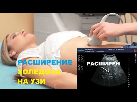 Видео: Как выглядит РАСШИРЕННЫЙ ХОЛЕДОХ на УЗИ?