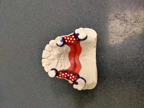 Видео: Моделирование восковых композиций каркаса бюгельного протеза