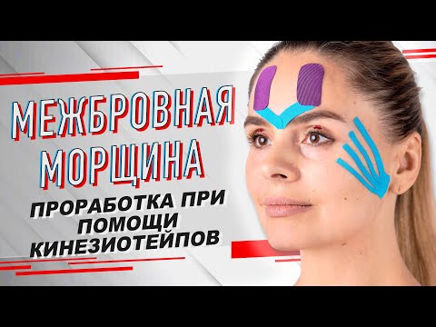 Видео: ▶️ МЕЖБРОВНАЯ МОРЩИНА /МЕТОДИКА ПРОРАБОТКИ ПРИ ПОМОЩИ КИНЕЗИОТЕЙПИРОВАНИЯ | Валентин Гайт | BBALANCE