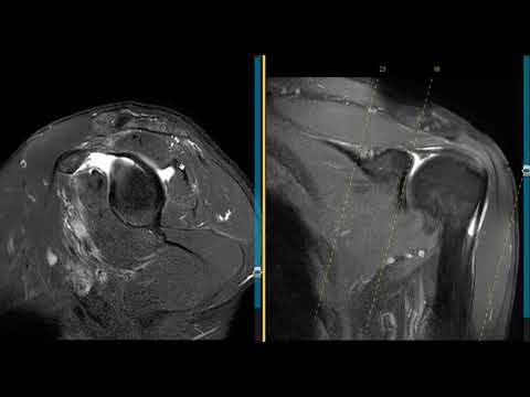 Видео: Разрыв SLAP у 52-летнего баскетболиста